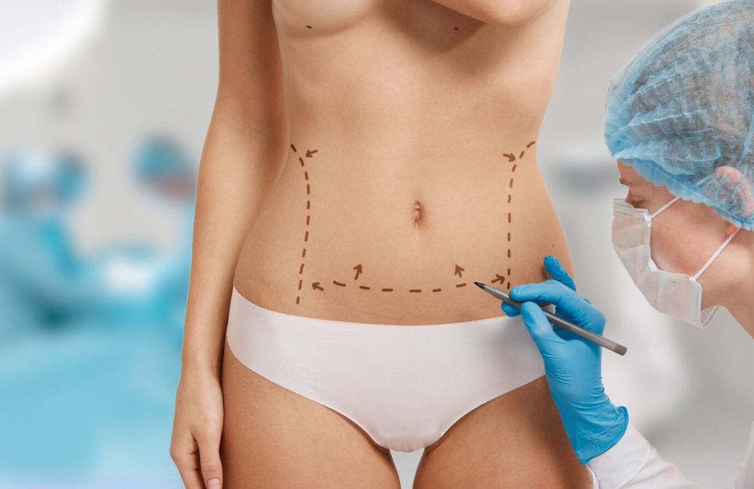 Abdominoplastie