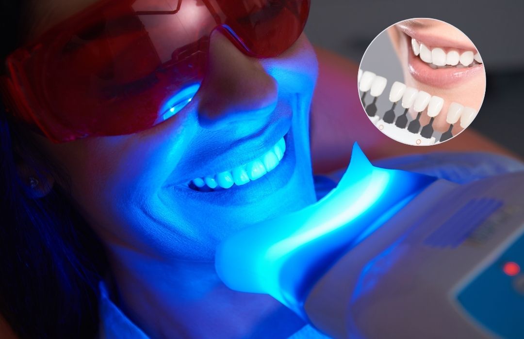 Blanchiment Dentaire